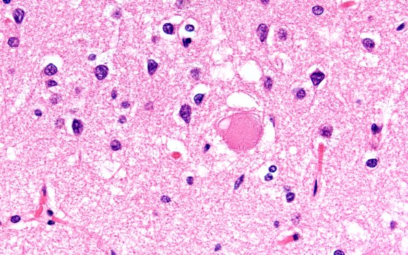 5B6 CBD N3 (Case 5) Cingulate H&E 60X