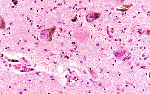 5C5 CBD N11 (Case 5) H&E SN 100X