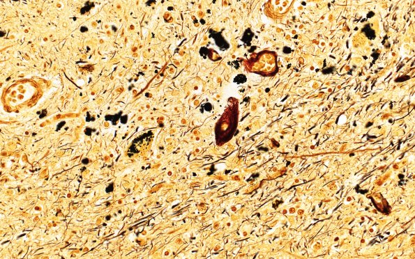 5D2 CBD N11 (Case 5) Biels 60X 1