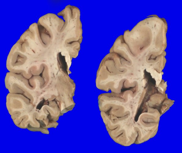 6A3 (Case 6) Gross  _5