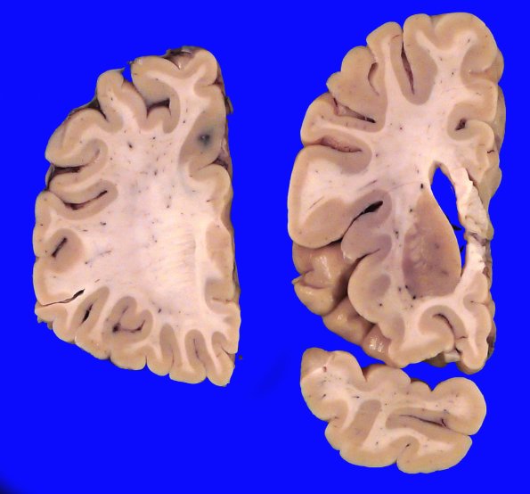 7A2 CBD (Case 7) Gross_4