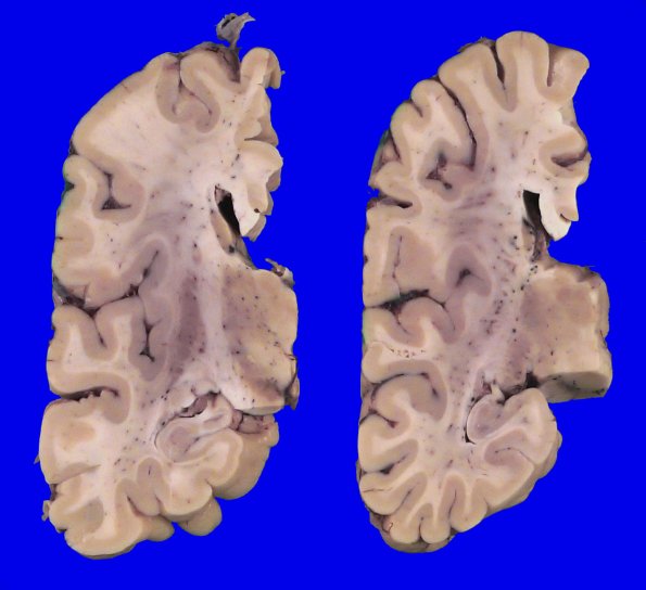 7A3 CBD (Case 7) Gross_6