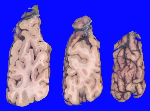 7A4 CBD (Case 7) Gross_8