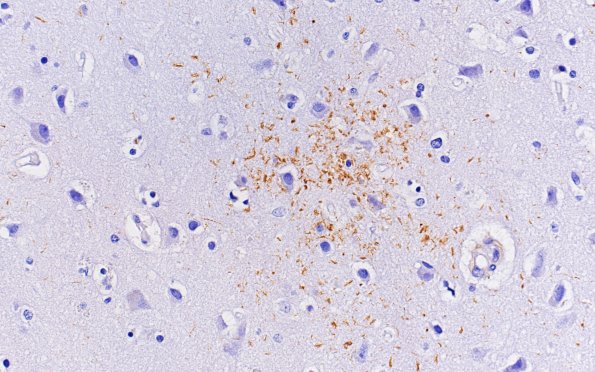 7D3 CBD (Case 7) L1 PHF1 40X 1