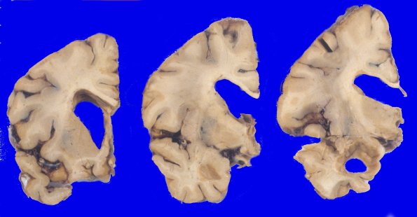 8A1 Corticobasal Degeneration (Case 8)