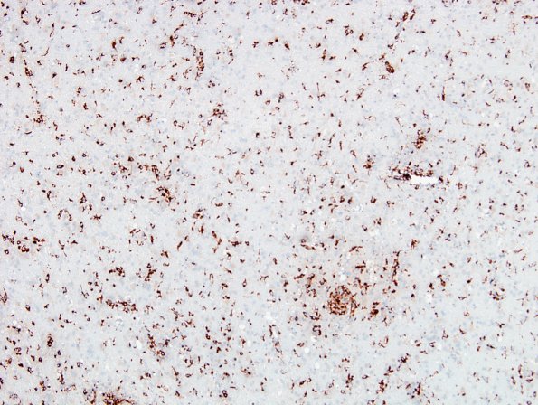 1C1 Crystal-Storing Histiocytosis (Case 1) CD68 24
