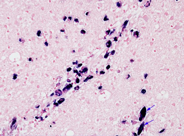 1E2 Crystal-Storing Histiocytosis (Case 1) ISH Kappa 4 copy