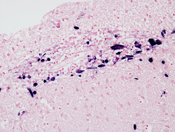1E3 Crystal-Storing Histiocytosis (Case 1) ISH Kappa 5