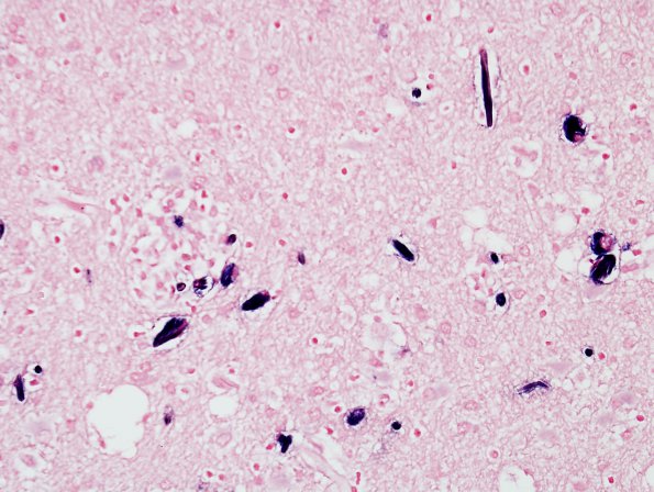 1E4 Crystal-Storing Histiocytosis (Case 1) ISH Kappa 3