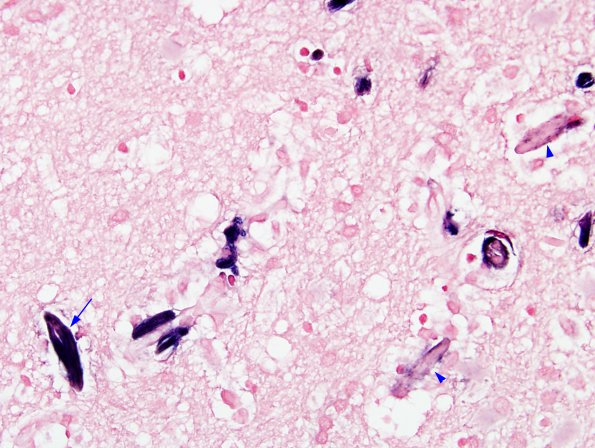 1E5 Crystal-Storing Histiocytosis (Case 1) ISH Kappa 8 copy