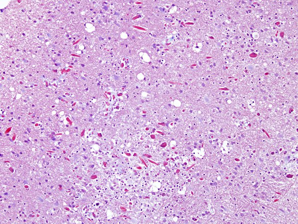 1G1 Crystal-Storing Histiocytosis (Case 1) Trichrome 2