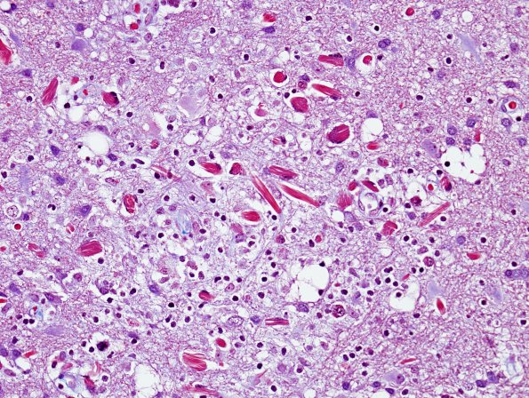 1G2 Crystal-Storing Histiocytosis (Case 1) Trichrome 3