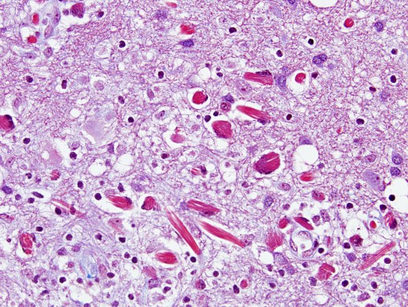1G3 Crystal-Storing Histiocytosis (Case 1) Trichrome 4