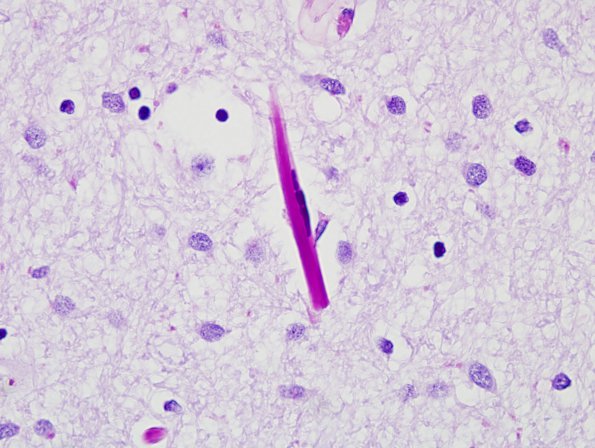1I5 Crystal-Storing Histiocytosis (Case 1) PAS & Diastase 6