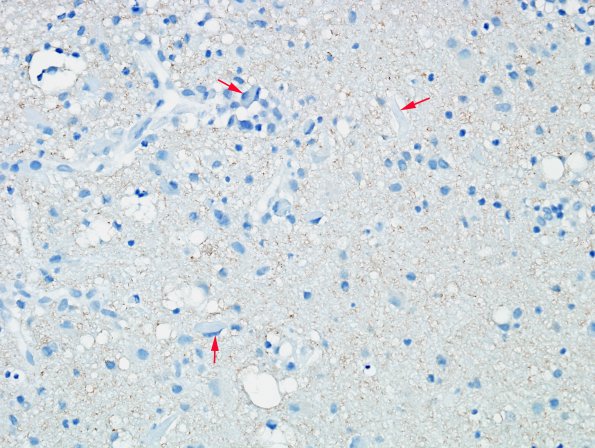1J1 Crystal-Storing Histiocytosis (Case 1) Tau 5 copy