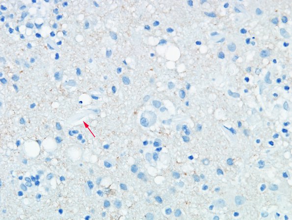 1J2 Crystal-Storing Histiocytosis (Case 1) Tau 1 copy