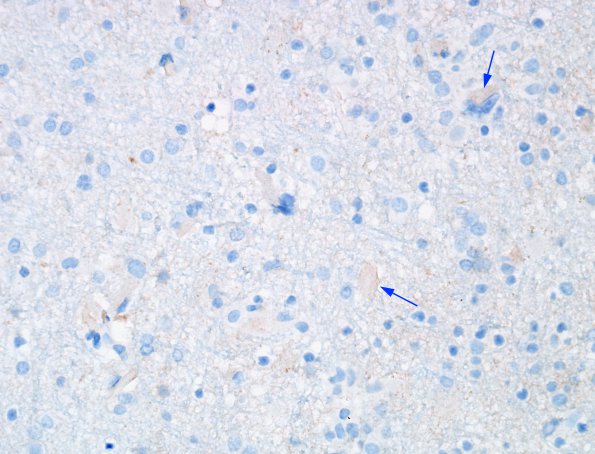 1K Crystal-Storing Histiocytosis (Case 1) B-amyloid 8 copy