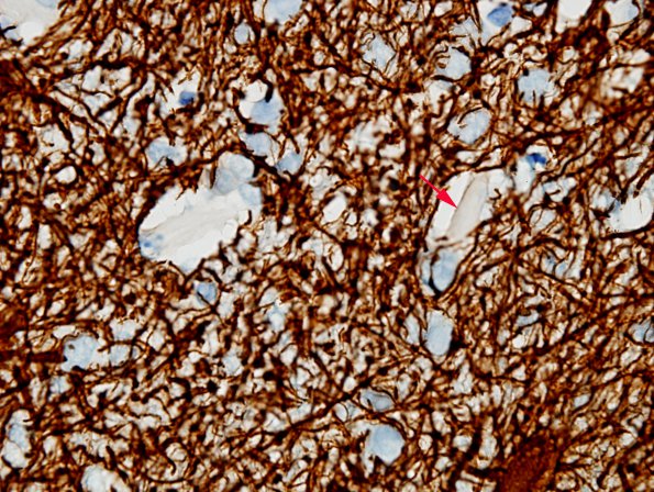 1M1 Crystal-Storing Histiocytosis (Case 1) GFAP 2 copy