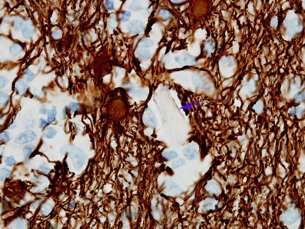 1M2 Crystal-Storing Histiocytosis (Case 1) GFAP 6 copy