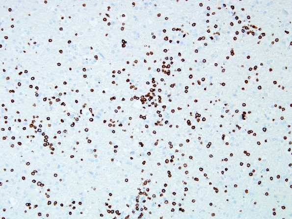 1O Crystal-Storing Histiocytosis (Case 1) CD3