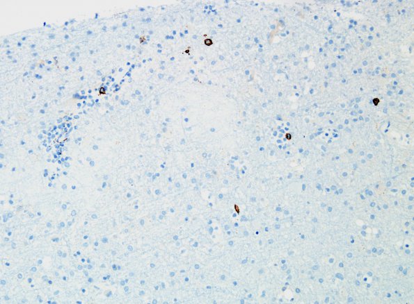 1P Crystal-Storing Histiocytosis (Case 1) CD20