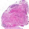 2A1 Crystal-Storing Histiocytosis (AANP 2012 Case 10) H&E 4X