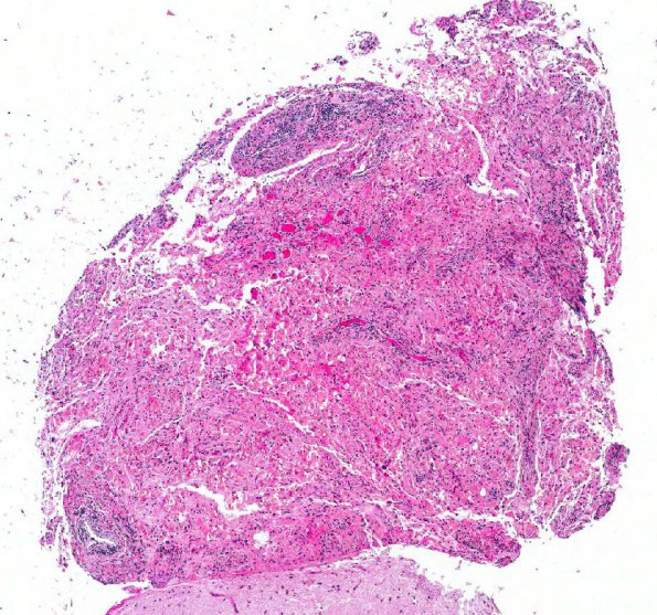 2A1 Crystal-Storing Histiocytosis (AANP 2012 Case 10) H&E 4X