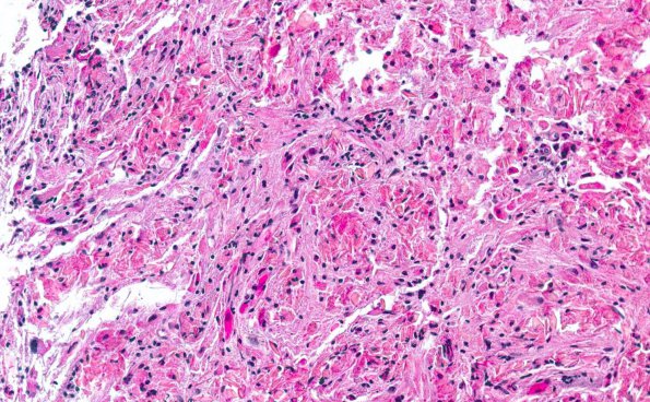 2A2 Crystal-Storing Histiocytosis (AANP 2012 Case 10) H&E 3