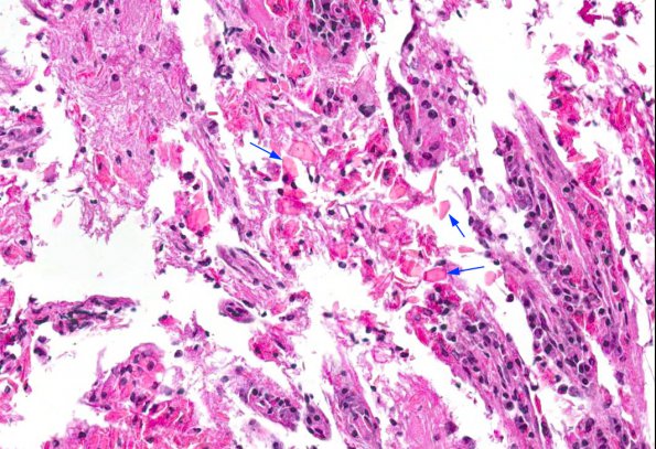 2A4 Crystal-Storing Histiocytosis (AANP DSS 2012-Case 10) 4 Crystals copy
