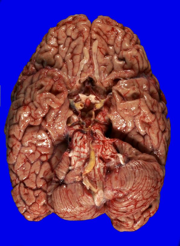 1A1 Globular Glial Tauopathy (Case 1) _1A