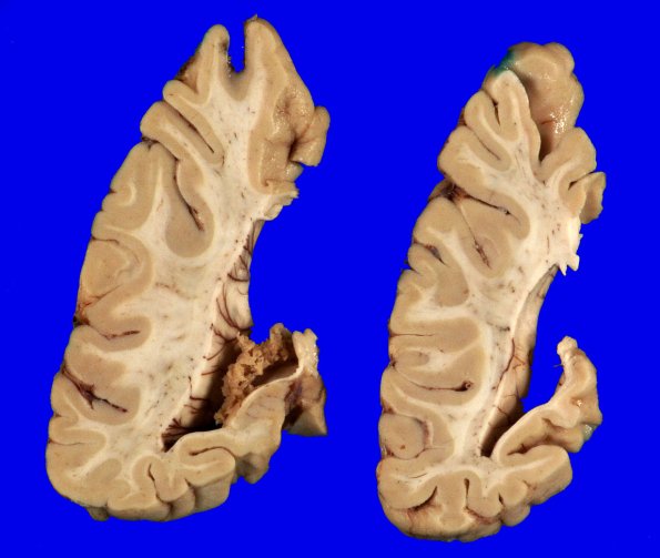 1A10 Globular Glial Tauopathy (Case 1) _13