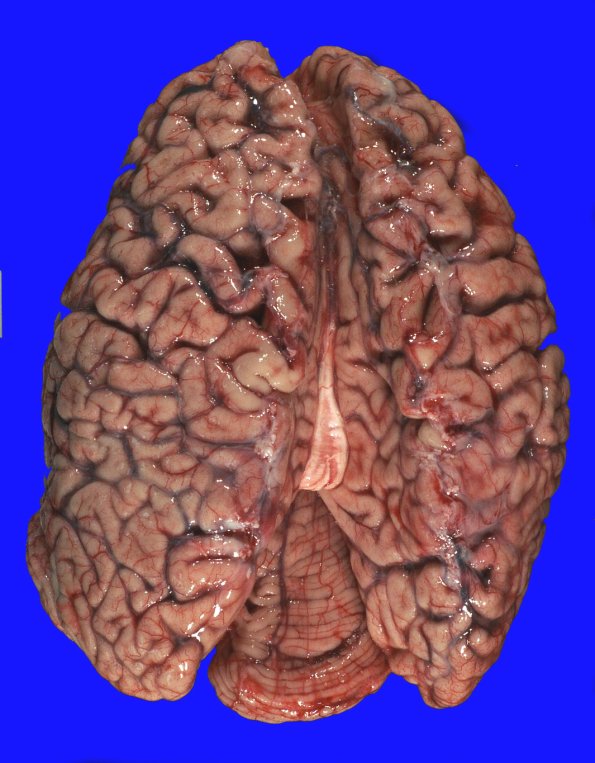 1A2 Globular Glial Tauopathy (Case 1) _2