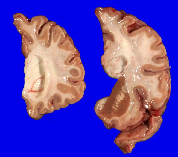 1A3 Globular Glial Tauopathy (Case 1) _4