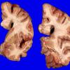 1A4 Globular Glial Tauopathy (Case 1) _5