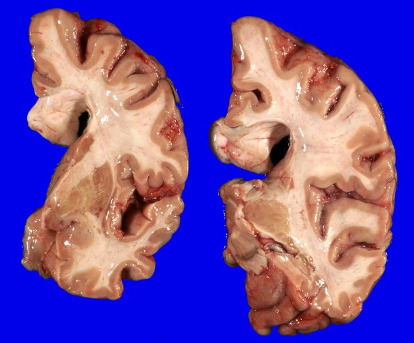 1A4 Globular Glial Tauopathy (Case 1) _5