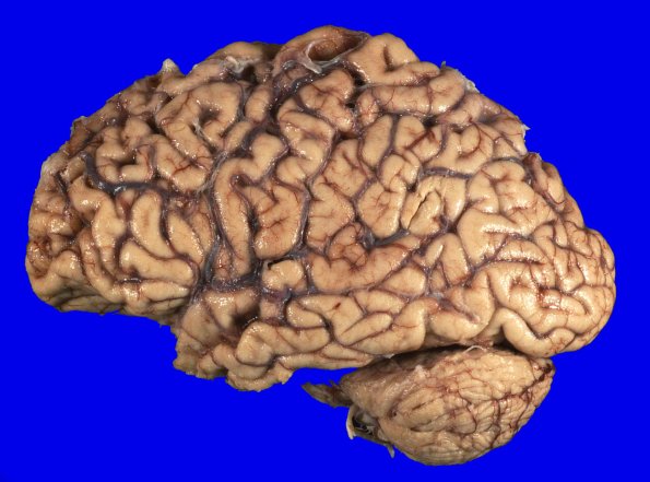 1A5 Globular Glial Tauopathy (Case 1) _7