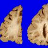 1A6 Globular Glial Tauopathy (Case 1) _9