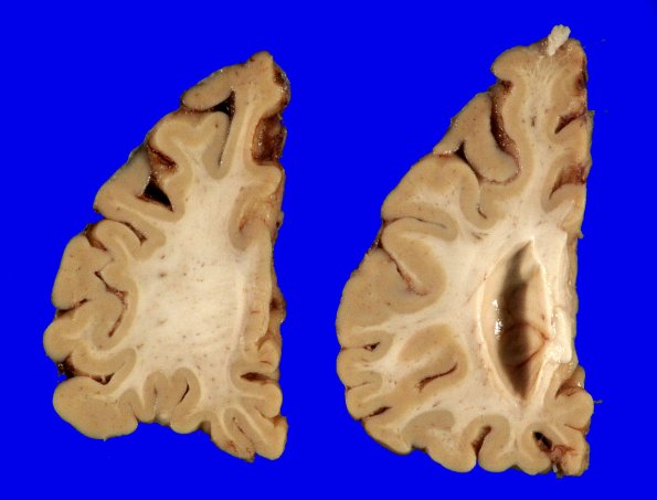 1A6 Globular Glial Tauopathy (Case 1) _9