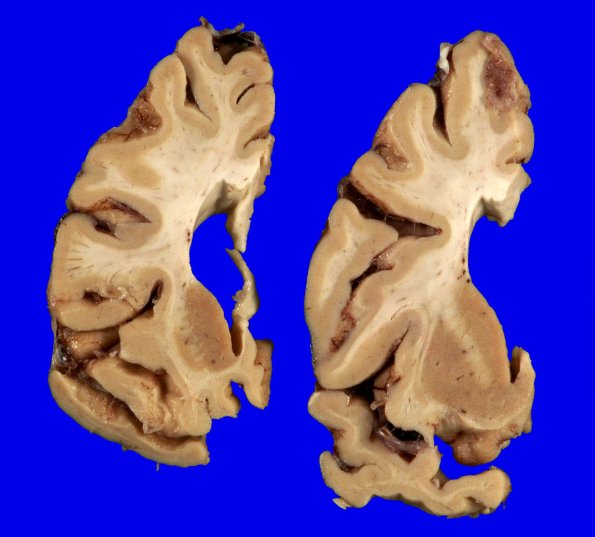 1A7 Globular Glial Tauopathy (Case 1) _10