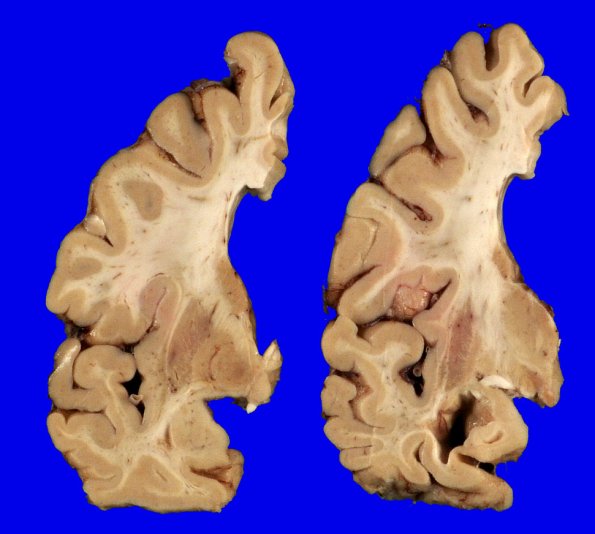 1A8 Globular Glial Tauopathy (Case 1) _11