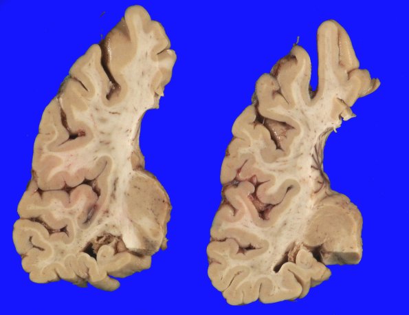 1A9 Globular Glial Tauopathy (Case 1) _12