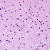 1B4 Globular Glial Tauopathy (Case 1) L19 H&E 10.jpg