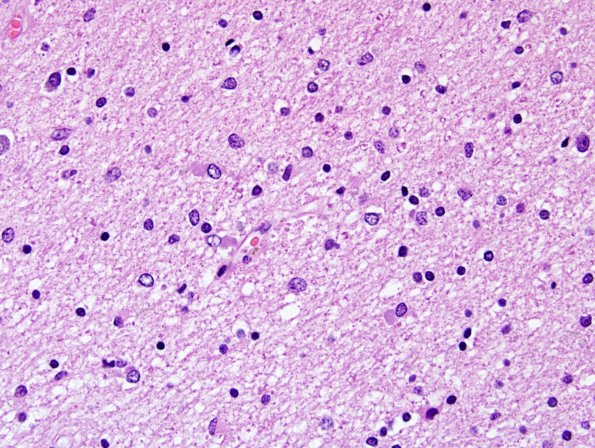 1B4 Globular Glial Tauopathy (Case 1) L19 H&E 10.jpg