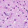 1B5 Globular Glial Tauopathy (Case 1) L19 H&E 1 copy.jpg