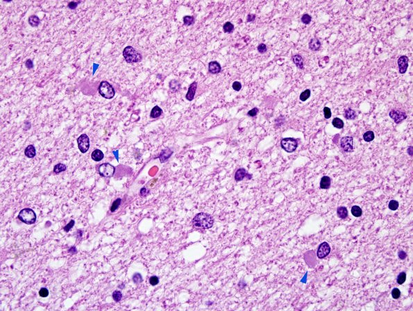 1B5 Globular Glial Tauopathy (Case 1) L19 H&E 1 copy.jpg