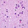 1B8 Globular Glial Tauopathy (Case 1) L19 H&E 2.jpg