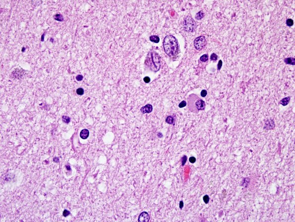 1B8 Globular Glial Tauopathy (Case 1) L19 H&E 2.jpg