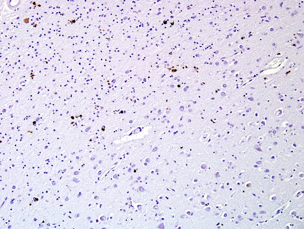 1C1 Globular Glial Tauopathy (Case 1) L19 PHF1 5.jpg