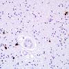 1C2 Globular Glial Tauopathy (Case 1) L19 PHF1 2.jpg