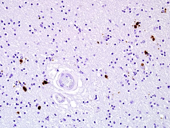 1C2 Globular Glial Tauopathy (Case 1) L19 PHF1 2.jpg